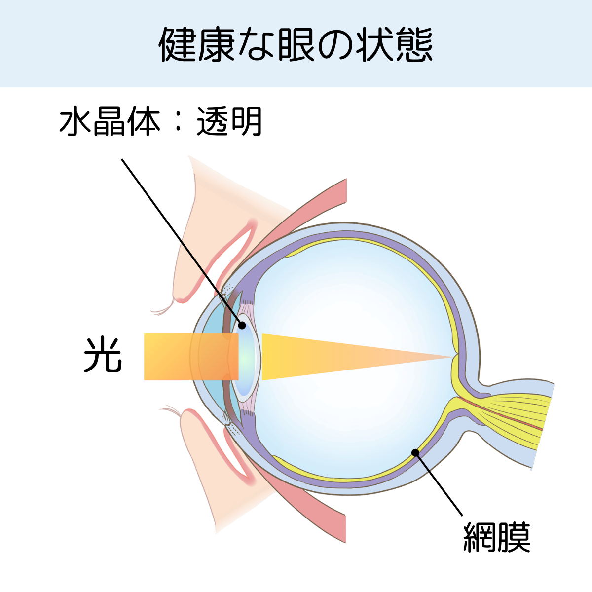 白内障 – 井上眼科医院